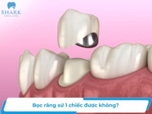 bọc răng sứ 1 chiếc được không