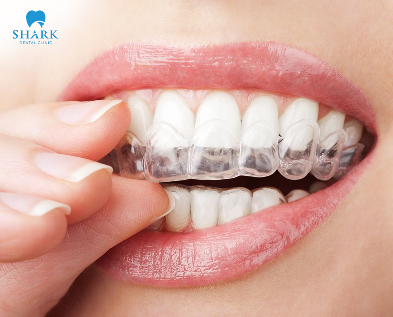 Niềng răng hô nhẹ giá bao nhiêu tiền? Có nên niềng không? 10 Niềng răng trong suốt để điều chỉnh sai lệch khớp cắn nhẹ