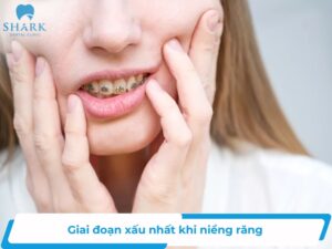 Giai đoạn xấu nhất khi niềng răng
