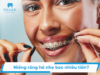 Răng hô là gì? Chi phí niềng răng hô hết bao nhiêu tiền?