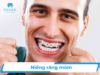 Niềng răng móm bao nhiêu tiền? Bảng giá niềng móm mới