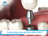 Trồng răng cấm giá bao nhiêu? Bảng giá trồng răng 9/2026