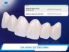 Giá bọc răng sứ Zirconia bao nhiêu 1 răng? Bảng giá mới nhất 2026
