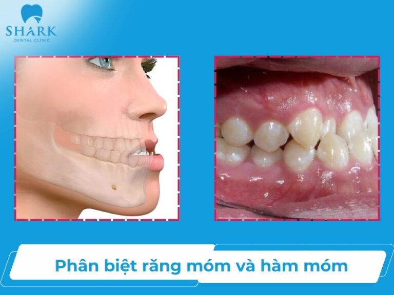 Đeo hàm duy trì vẫn bị chạy răng phải làm sao để khắc phục?