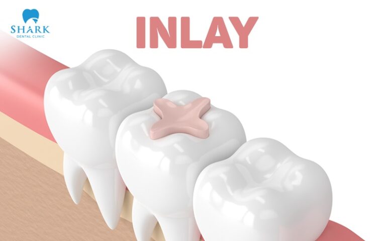 Trám răng Inlay Onlay và sơ lược những thông tin cơ bản