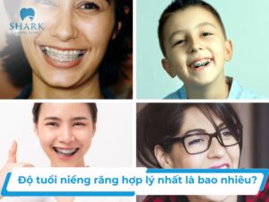 Độ tuổi niềng răng hợp lý