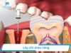Lấy chỉ máu răng là gì? Rút chỉ máu răng giá bao nhiêu tiền?