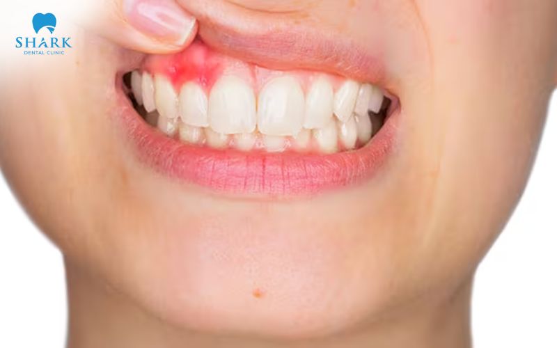 Bị mất răng số 6 có niềng răng được không? 7 Nướu răng phải khỏe mạnh