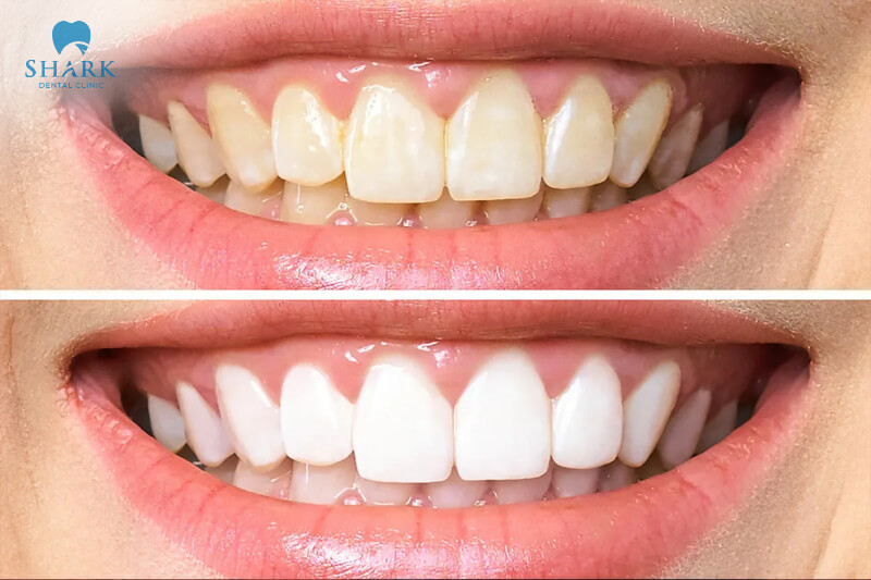 Răng bị ố vàng thì nên bọc sứ Zircornia