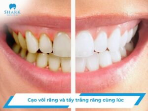 Cạo vôi răng và tẩy trắng răng cùng lúc có được không?