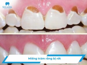Mieng tram rang bi rot