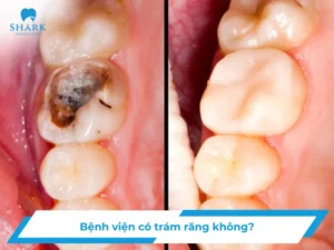 Bệnh viện có trám răng không
