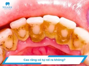 Cao răng tự rơi ra có tốt không