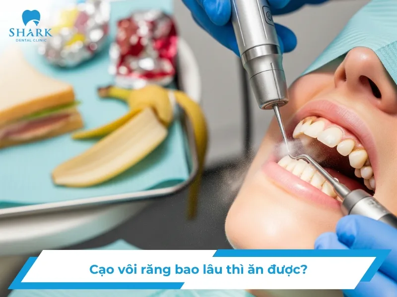 Cạo vôi răng bao lâu thì ăn được