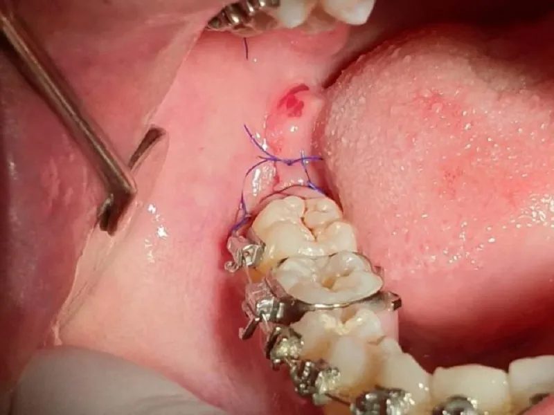Healing process after wisdom tooth extraction