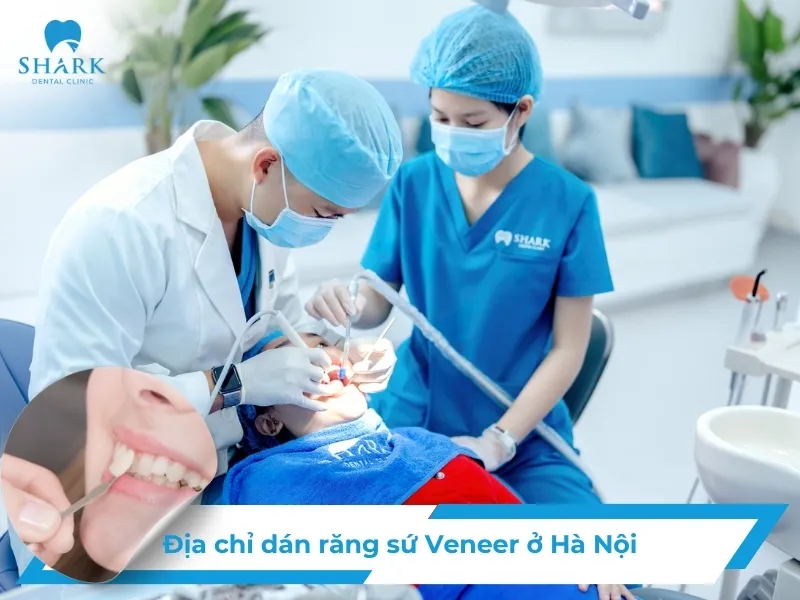 Địa chỉ dán sứ Veneer ở Hà Nội