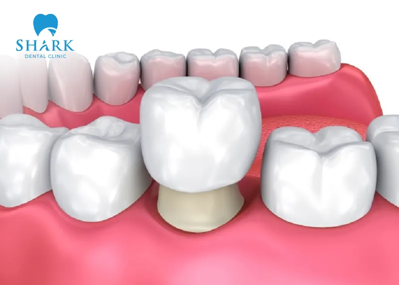 Quy trình bọc răng sứ cho răng sâu được thực hiện như thế nào? 6 Bọc răng sứ cho răng sâu tuân thủ đúng quy trình để có hiệu quả cao