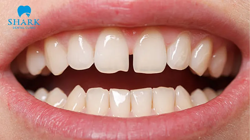 Răng bị thưa và mọc lệch cũng là vẫn đề hay gặp