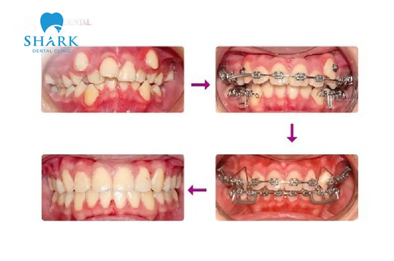 Hình ảnh trước và sau khi chữa răng lòi xỉ cho trẻ em