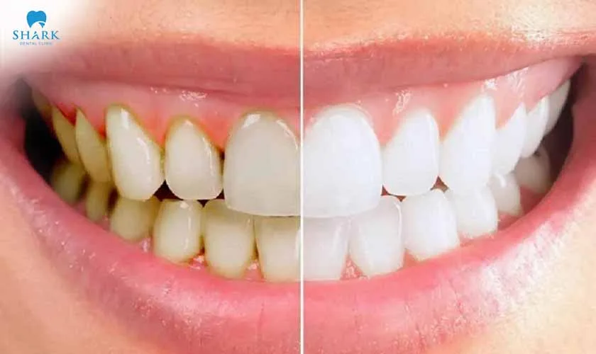 Tác hại của việc lấy cao răng sai cách - Cách để phòng tránh 6 Lấy cao răng có thể tổn hại đến mô và nướu