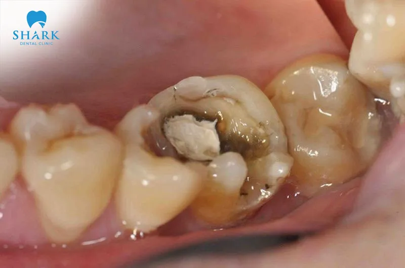 Răng sâu không trám gây viêm nhiễm, có thể khiến mất răng