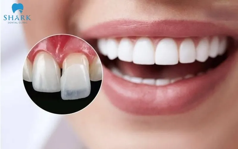 Bảng giá bọc răng sứ bệnh viện Răng Hàm Mặt chi tiết năm 2025 9 Mài cùi răng tại bệnh viện răng hàm mặt được thực hiện nhanh chóng nhờ sự hỗ trợ của máy móc, công nghệ hiện đại.