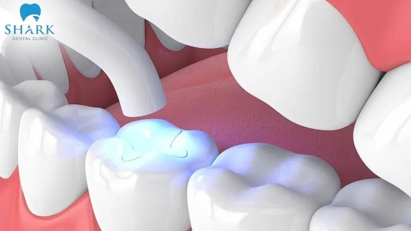 Phụ nữ mang bầu có trám răng được không? Cần lưu ý gì? 10 Trám răng Composite là phù hợp nhất đối với phụ nữ đang mang bầu