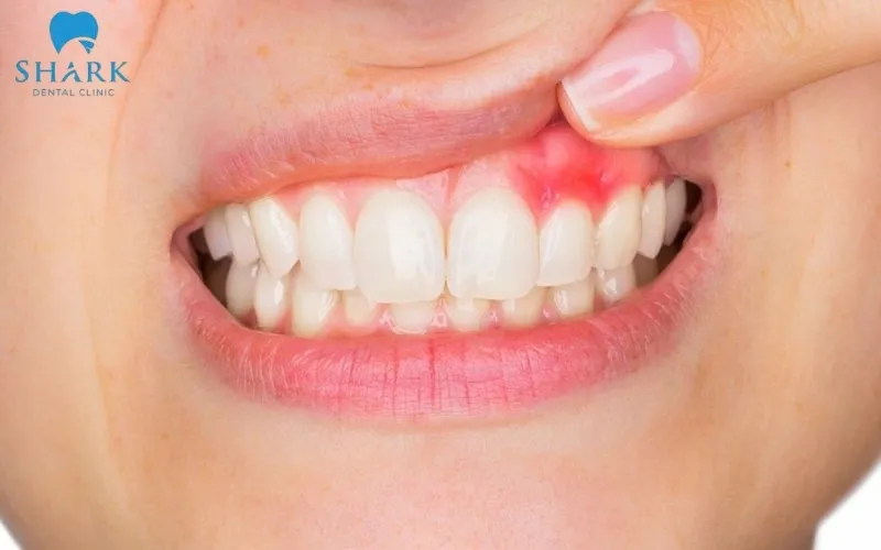 Bác sĩ giải đáp: Bị nha chu có bọc răng sứ được không? 6 Bị nha chu có bọc răng sứ được không? Theo các chuyên gia là không nên thực hiện