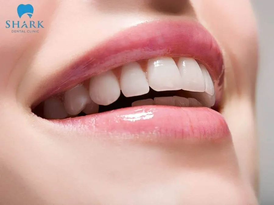 Bọc răng sứ Ceramill là gì? Những thông tin cần biết 9 Răng sứ Ceramill được giới chuyên môn đánh giá cao về mặt thẩm mỹ và độ chịu lực tốt