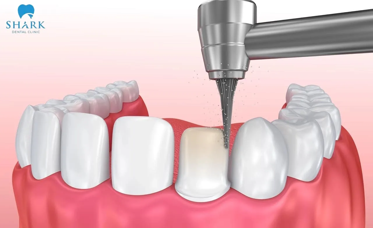 Bọc răng sứ Ceramill là gì? Những thông tin cần biết 11 Ceramill rất mỏng và nhẹ, chỉ dày 0.2 - 0.3mm nên không cần mài nhỏ lại