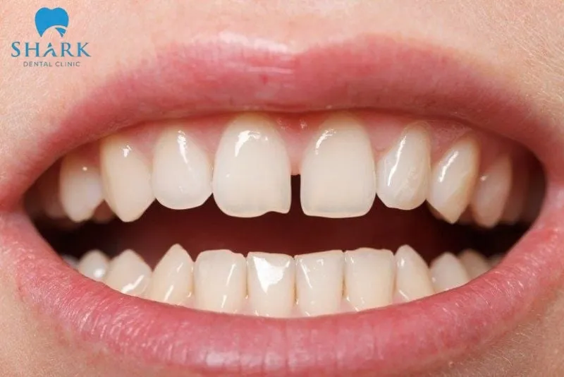 Bọc răng sứ Ceramill là gì? Những thông tin cần biết 13 Bọc răng sứ Ceramill phù hợp thực hiện với người có hàm răng thưa ở mức độ nhẹ