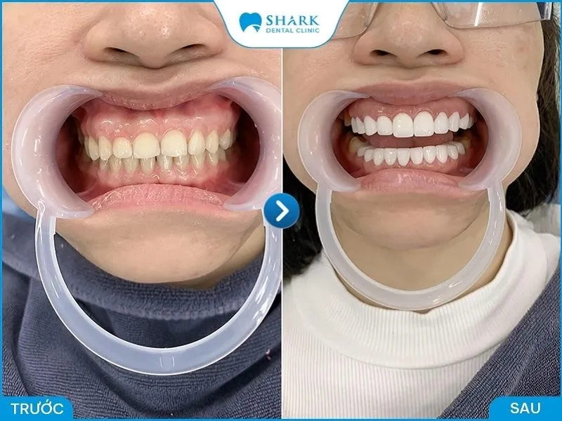 Bọc răng sứ Ceramill là gì? Những thông tin cần biết 15 Bọc răng sứ tại Nha Khoa Shark đem lại hiệu quả tối ưu về thẩm mỹ