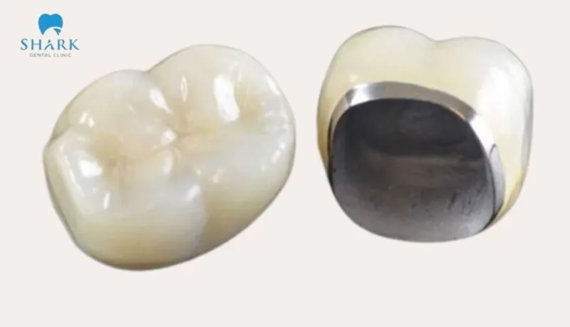 Bọc răng sứ có được bảo hiểm không? Giải đáp chi tiết từ A-Z 12 Răng sứ kim loại thường sẽ rất dễ bị đen viền nướu sau một thời gian dài sử dụng