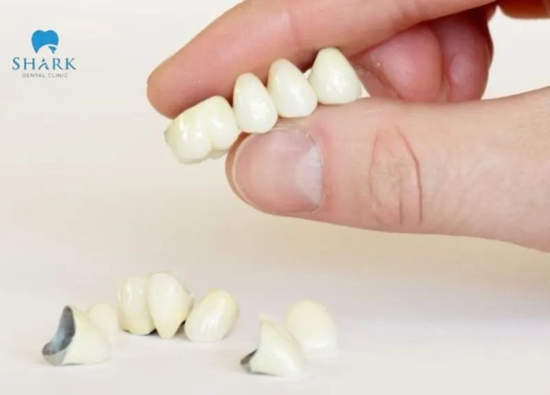 Bọc răng sứ có được bảo hiểm không? Giải đáp chi tiết từ A-Z 13 Răng bọc sứ Titan ít gây kích ứng và khó bị oxi hóa