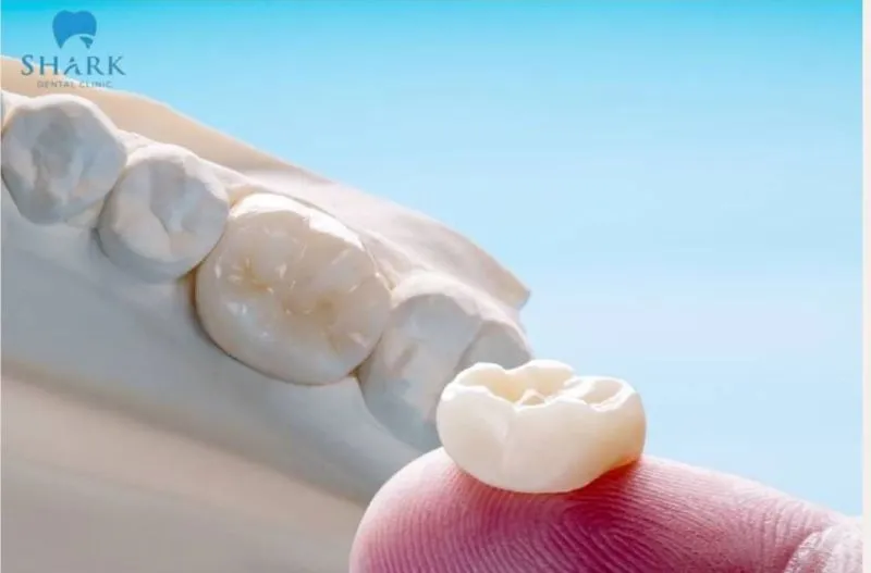 Bọc răng sứ có được bảo hiểm không? Giải đáp chi tiết từ A-Z 15 Răng sứ Emax là dòng sứ cao cấp với giá thành cao nhất trong các loại răng sứ
