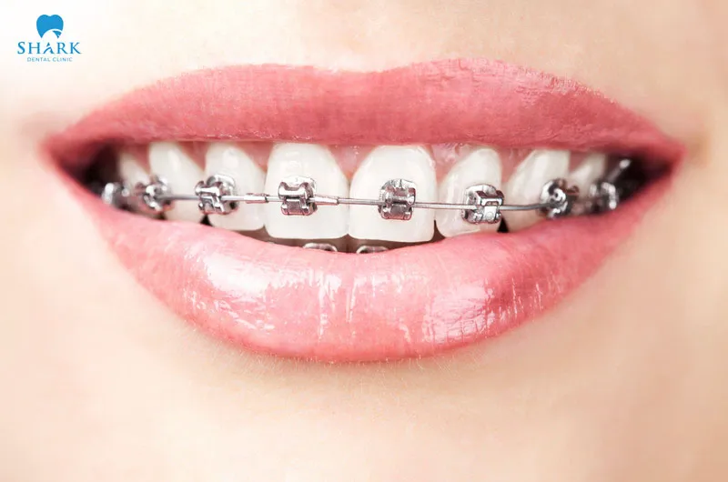 Niềng răng vẫn là giải pháp tối ưu nhất cho trường hợp răng không đều
