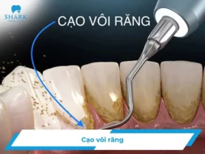 Cạo vôi răng