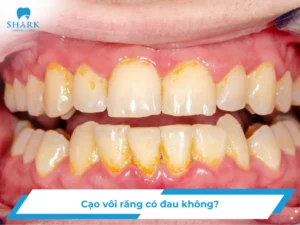 Cạo vôi răng có đau không