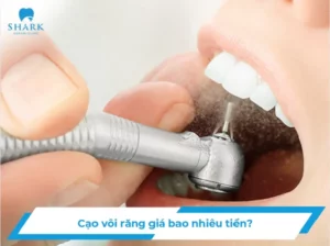 Cạo vôi răng giá bao nhiêu tiền