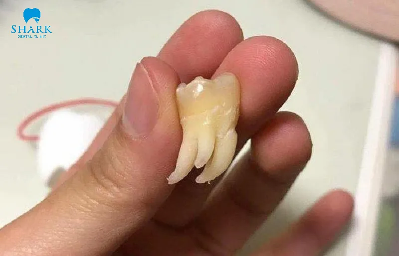 Chân của răng khôn