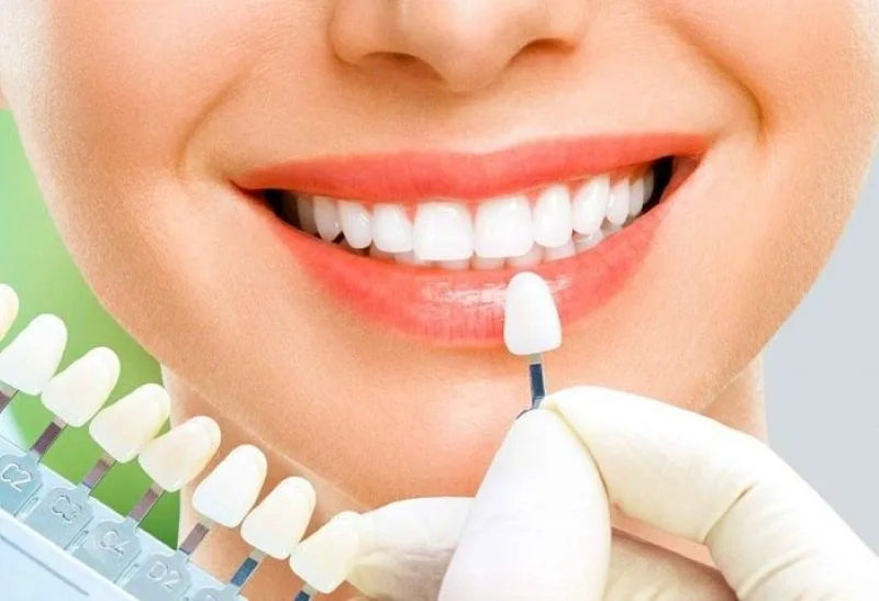 Top 12 địa chỉ bọc răng sứ tại Hà Nội uy tín và an toàn 17 Lựa chọn được địa chỉ bọc răng sứ uy tín tại Hà Nội rất quan trọng