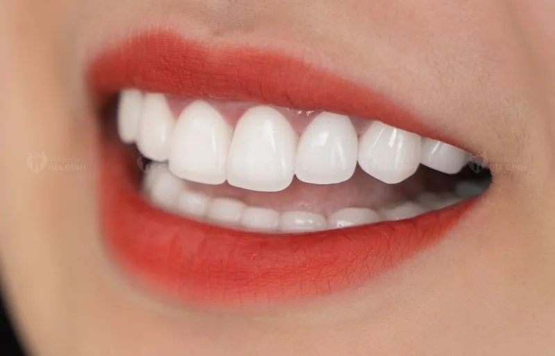 Top 12 địa chỉ bọc răng sứ tại Hà Nội uy tín và an toàn 29 Nha khoa Gia đình là nơi bọc răng sứ Hà Nội được nhiều khách hàng tin chọn