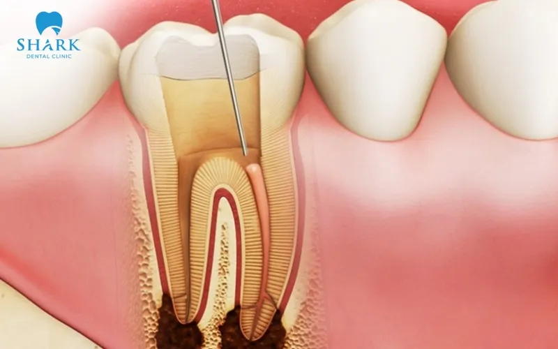 Viêm tủy răng cấp là một trong những dấu hiệu cho thấy bạn nên điều trị nội nha càng sớm càng tốt để phòng vấn đề hỏng tủy