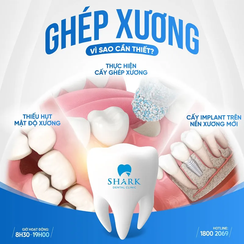 Ghép xương răng trong cấy Implant là gì? Dành cho ai? 17 Ghép xương răng là tiền đề để cấy Implant ổn định trong nhiều trường hợp