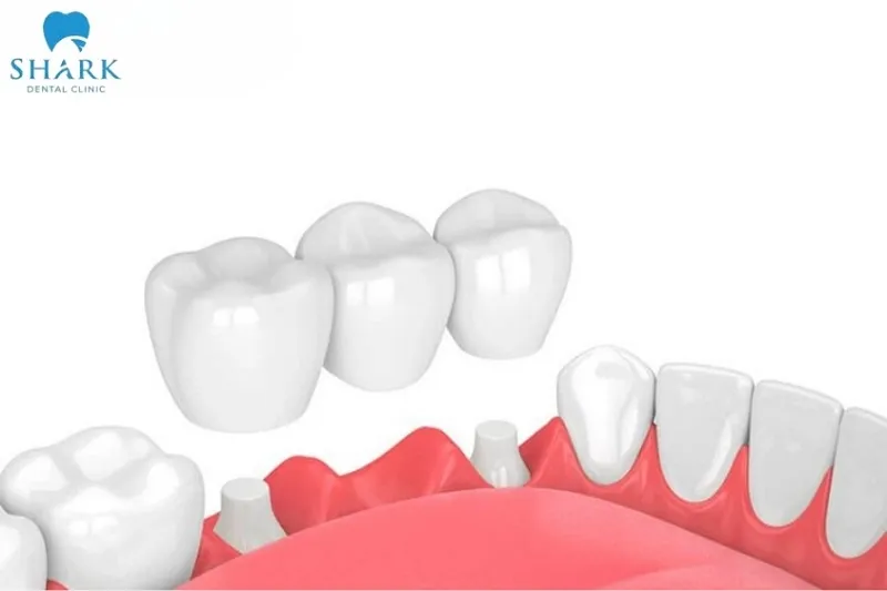 Sau khi đã hoàn thành chế tạo cầu răng sứ, khách hàng trở lại nha khoa để được các bác sĩ tiến hành lắp răng sứ