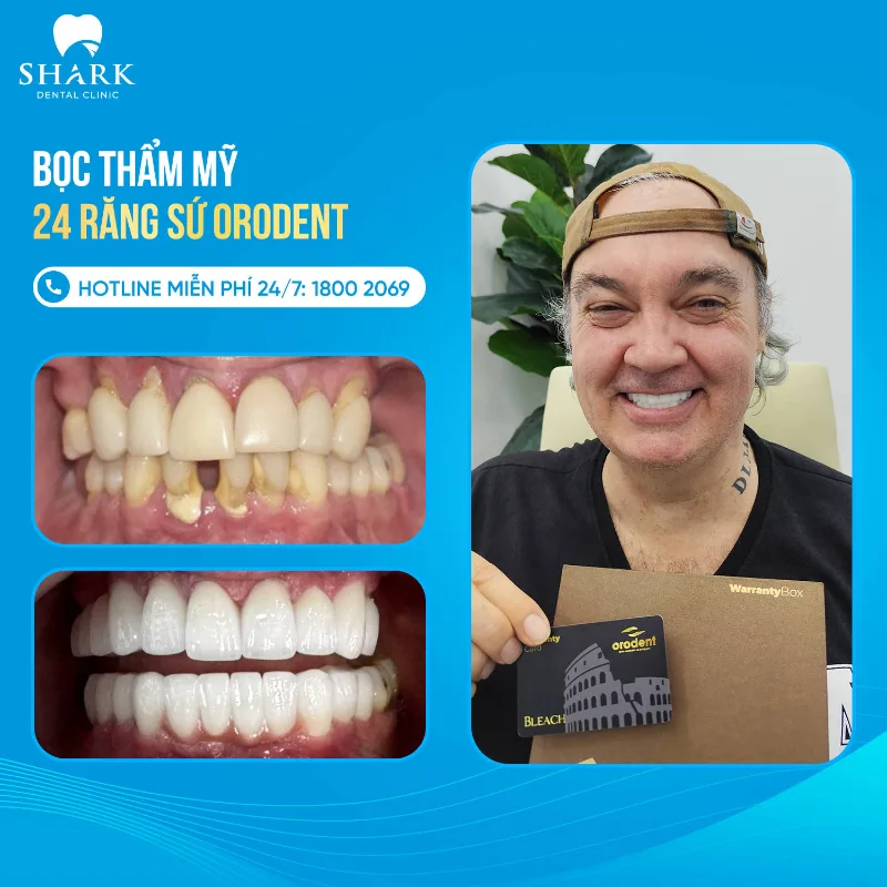 Bọc thẩm mỹ 24 răng sứ Orodent