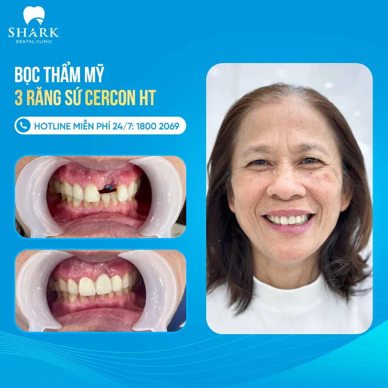 Bọc sứ 3 răng Cercon HT