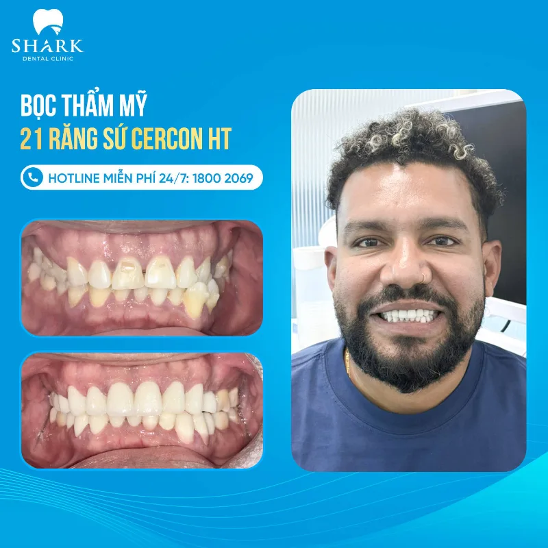 Mr. Mervyn tin chọn bọc răng sứ Cercon HT