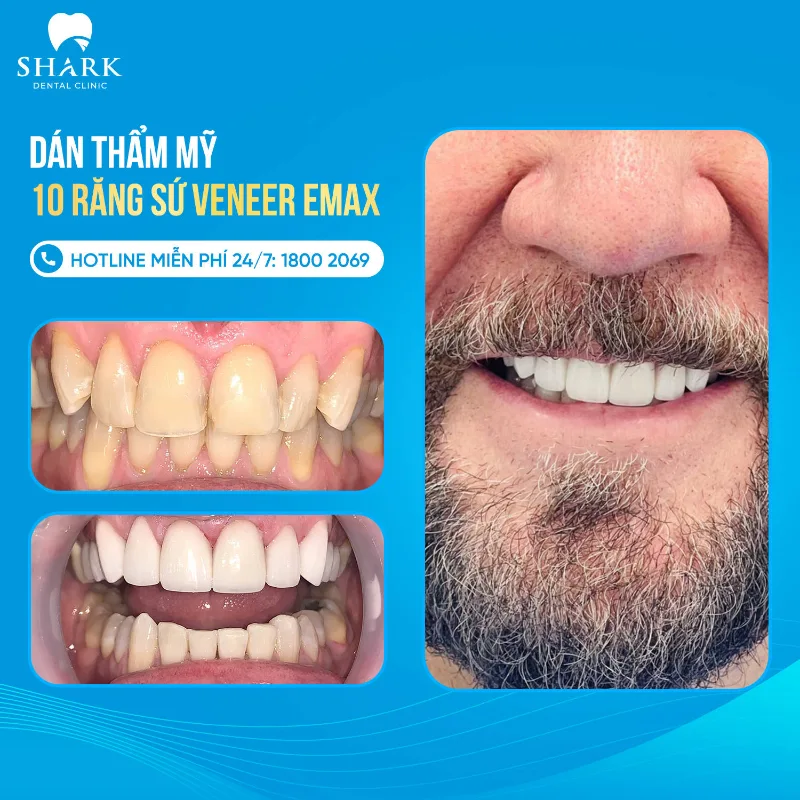 Dán răng sứ Veneer Emax
