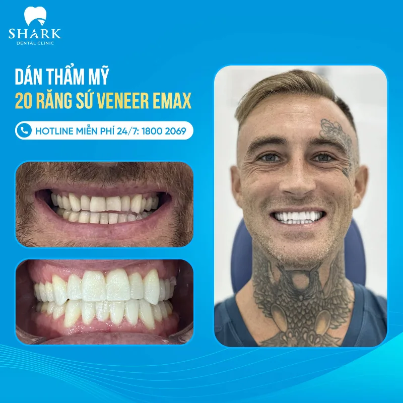Patrick dán răng sứ Veneer Emax